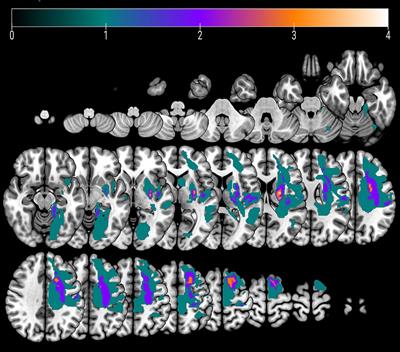 The role of ventral tegmental area in chronic stroke rehabilitation: an exploratory study